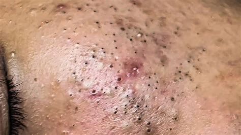 blackheads 2021 new videos